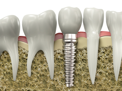 Dental Implants for less than $2000